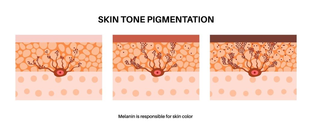 Hyperpigmentation Skincare Routine in Singapore