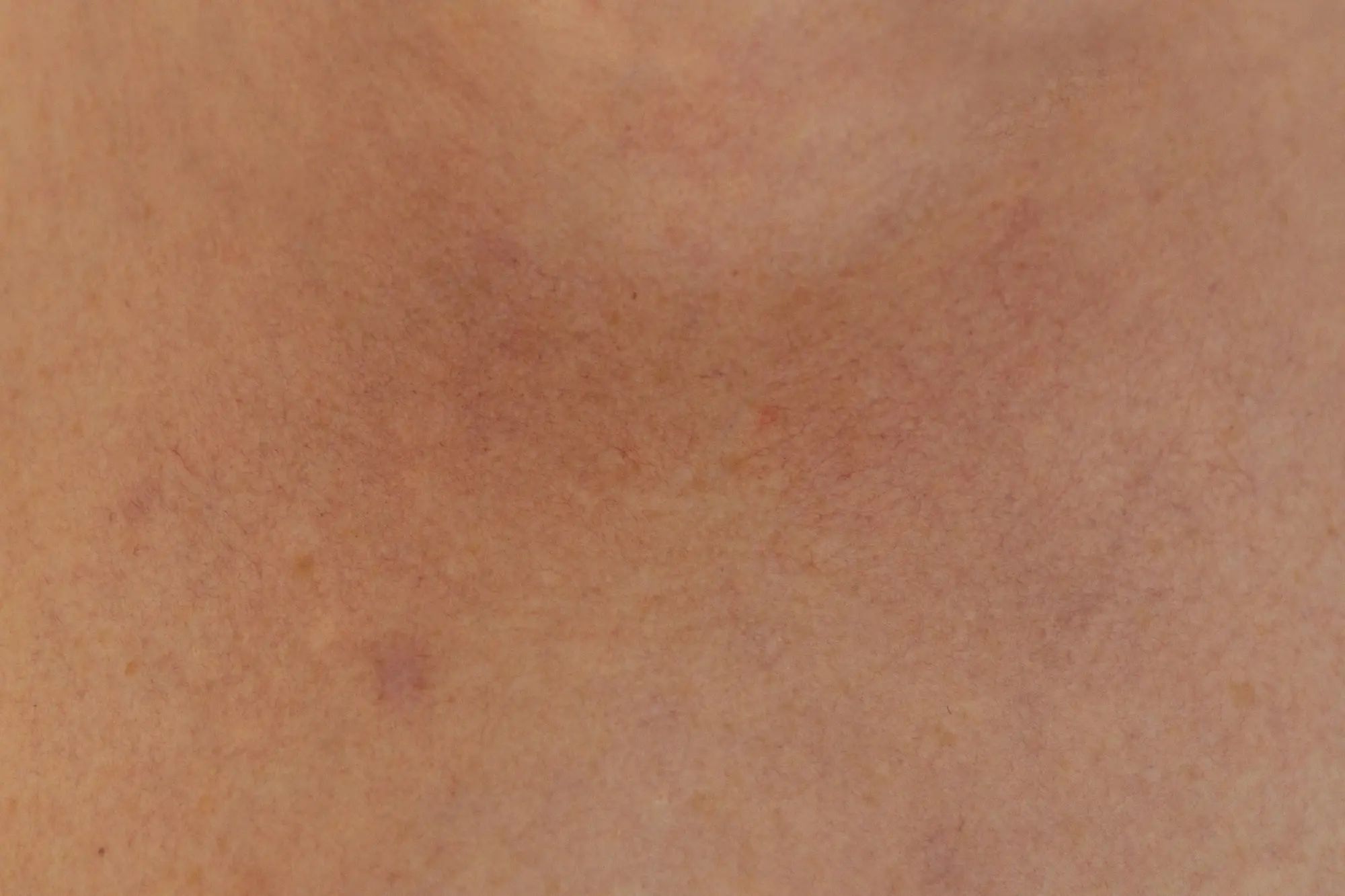 low skin pH level