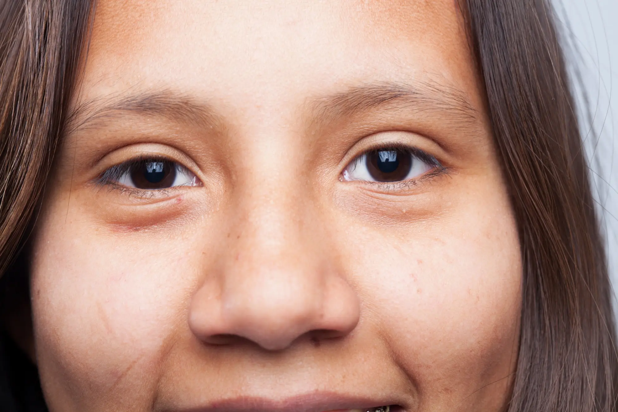 causes of under eye puffiness skincare