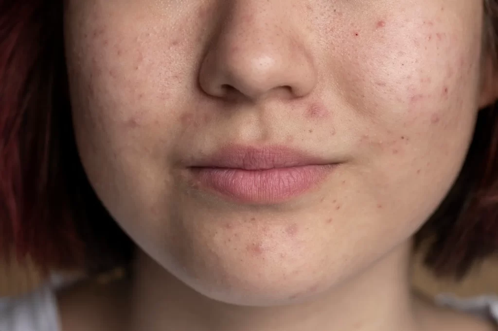 how to fade hyperpigmentation dark spots guide