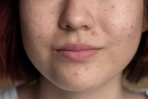 how to fade hyperpigmentation dark spots guide
