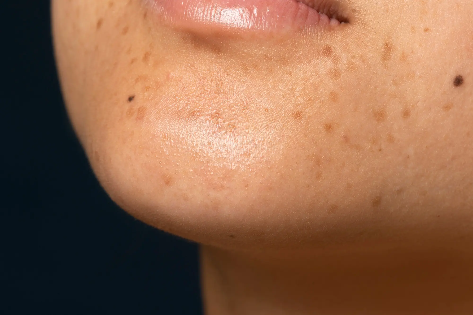types of hyperpigmentation explained