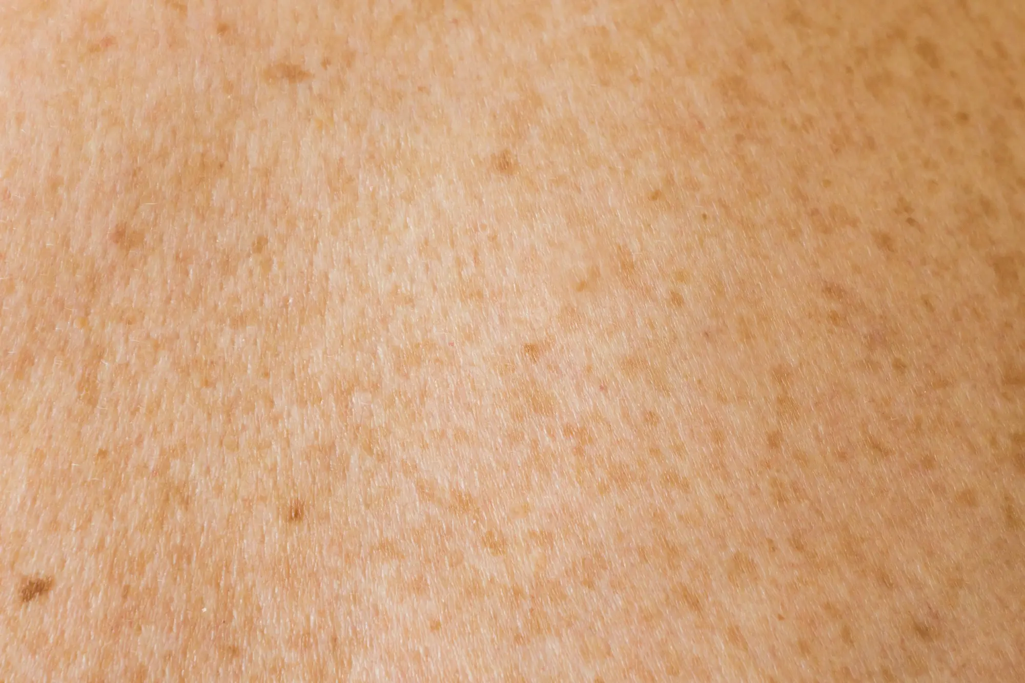 causes of ceramide loss in skin