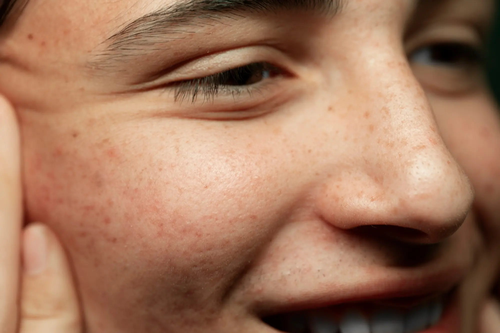 dark spots on face
