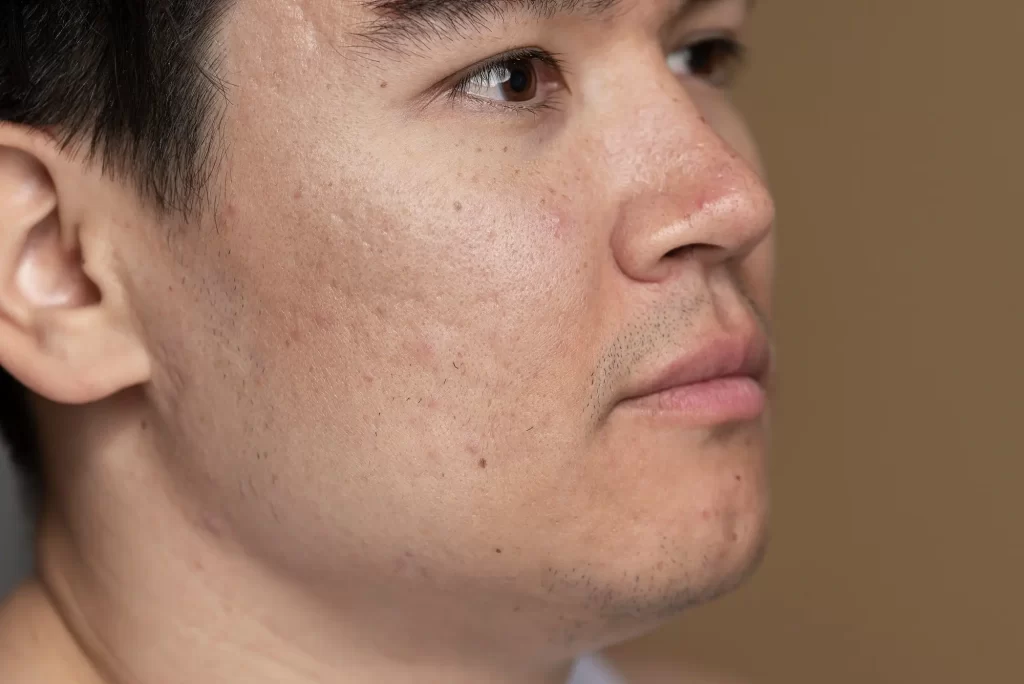 how to minimise large pores