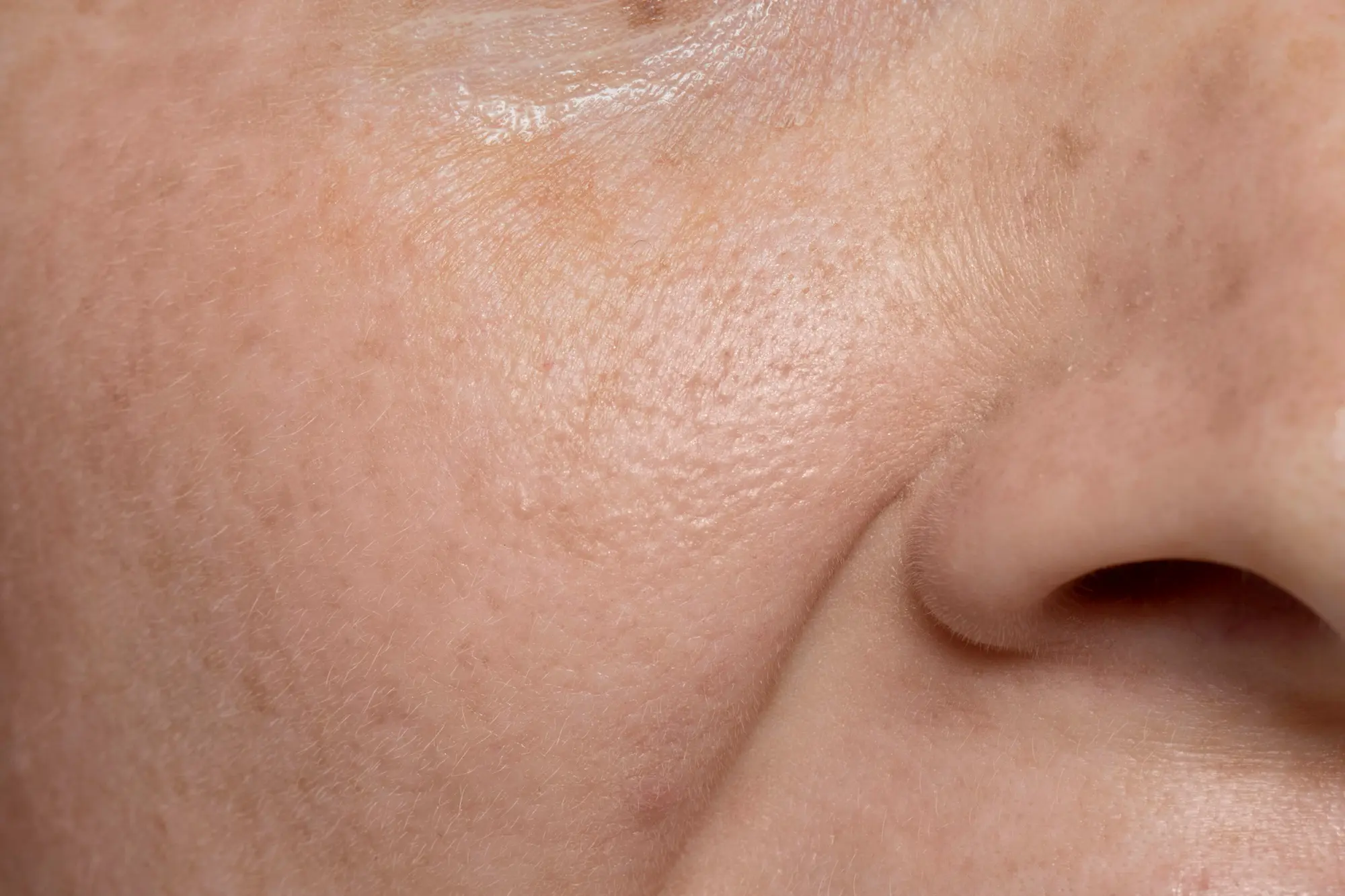 how to minimise large pores