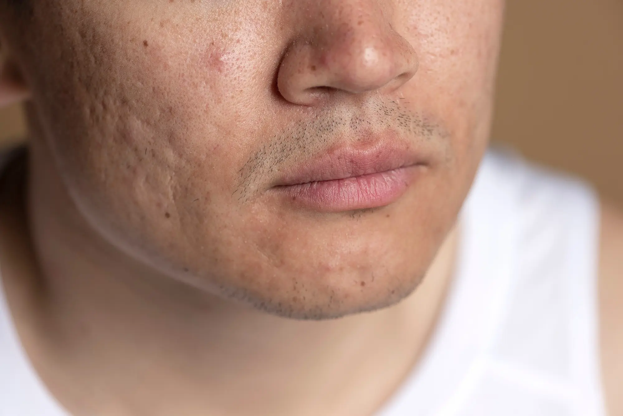 how to minimise large pores